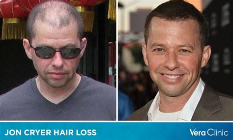 Jon cryer hair loss - Jon Cryer Hair Transplant. Born April 16, 1965, Jon Cryer is famous for being a TV …